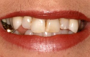 crooked-smile-crooked-teeth